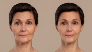 Antes y después del tratamiento de radiofrecuencia facial 