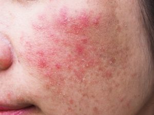 Principales patologías de la piel que debes conocer si estudias estética