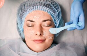 qué son los Peelings químicos, para qué sirven y tipos